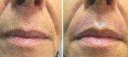 Skin Resurfacing with Er:YAG Laser
Perilabial Wrinkles


Courtesy of Prof. P. Bonan, MD - Prof. P. Campolmi, MD - Prof. G. Cannarozzo, MD. Florence – Italy