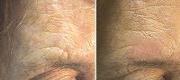 Traumatic Scar Treated with Er:YAG Laser


Courtesy of Prof. P. Bonan, MD - Prof. P. Campolmi, MD - Prof. G. Cannarozzo, MD. Florence – Italy