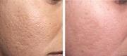 Acne Scars Treated with Er:YAG Laser


Courtesy of  N. Zerbinati, MD. Pavia – Italy