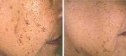 Skin Surgery 
Brown Spots Treated with Er:YAG Laser


Courtesy of Prof. P. Bonan, MD - Prof. P. Campolmi, MD - Prof. G. Cannarozzo, MD. Florence – Italy