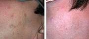 Skin Surgery 
Lentigo Senilis Treated with Er:YAG Laser


Courtesy of A. Pacifici, MD. Perugia – Italy