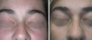 Skin Surgery 
Xanthelasma Treated with Er:YAG Laser


Courtesy of A. Pacifici, MD. Perugia – Italy