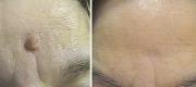 Skin Surgery 
Keratoacanthoma Treated with Er:YAG Laser

Courtesy of Prof. P. Bonan, MD - Prof. P. Campolmi, MD - Prof. G. Cannarozzo, MD. Florence – Italy