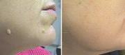 Skin Surgery 
Dermal Nevus Treated with Er:YAG Laser


Courtesy of Prof. P. Bonan, MD - Prof. P. Campolmi, MD - Prof. G. Cannarozzo, MD. Florence – Italy