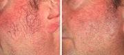 Facial Telangiectasias 
Treatment with Nd:YAG Laser

Courtesy of P. Bonan, MD – P. Campolmi, MD – G. Cannarozzo, MD. Florence, Italy