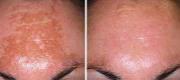 Melasma 
Trattamento con Luce Pulsata FT

Courtesy of M. Patarin, MD - Challans, France