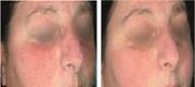 Rosacea – RightLightTM Technology

Courtesy of: Prof. P. Bonan, M.D. - Prof. P. Campolmi, M.D. - Prof. G. Cannarozzo, M.D. - Florence, Italy.