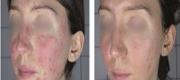 Rosacea- RightLightTM Technology

Courtesy of: Prof. P. Bonan, M.D. - Prof. P. Campolmi, M.D. - Prof. G. Cannarozzo, M.D. - Florence, Italy.