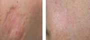 Combined treatment of scars with DOT + RF.

Courtesy of: N. Zerbinati, M.D. Varese - Italy.