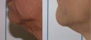 Skin Tightening

Per gentile concessione della Dr.ssa F. Tamburi - Roma, Italia