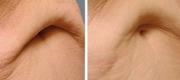 Skin Tightening

Courtesy of: Dr. G. Chernoff - Indianapolis, Usa