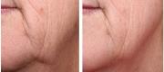 Anti-aging & Wrinkles 

Courtesy of: Dr. G. Allen - Vancouver , Usa