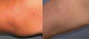 Body Shaping & Cellulite 
Courtesy of: Dr. G. Chernoff - Indianapolis, Usa