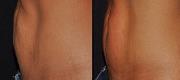 Body Shaping & Cellulite

Courtesy of: Dr. A. Pacifici - Perugia, Italia