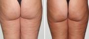 Body Shaping & Cellulite

Courtesy of: Dr. G. Scarcella - Verona, Italia