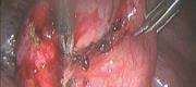 Laparoscopy: Treatmet of Endometriosis (1/3)


Courtesy of Maurizio Rosati MD, San Camillo Hospital, Trento Italy