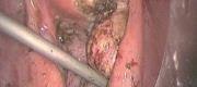 Laparoscopy: Treatmet of Endometriosis (3/3)

Courtesy of Maurizio Rosati MD, San Camillo Hospital, Trento Italy