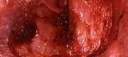 Colposcopic Microsurgery (2/5)
Vulvar Excision

By courtesy of Prof. C. Penna MD, M.G. Fallani MD. Careggi University Hospital - Florence, Italy