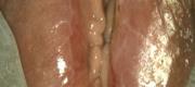 Colposcopic Microsurgery (4/5)
Vulvar Excision

By courtesy of Prof. C. Penna MD, M.G. Fallani MD. Careggi University Hospital - Florence, Italy