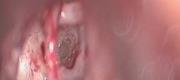 Ear Surgery
Stapedectomy: "One shot" CO₂ laser stapedectomy

By courtesy of S. Dallari MD. ENT Department, Fermo Hospital - Italy