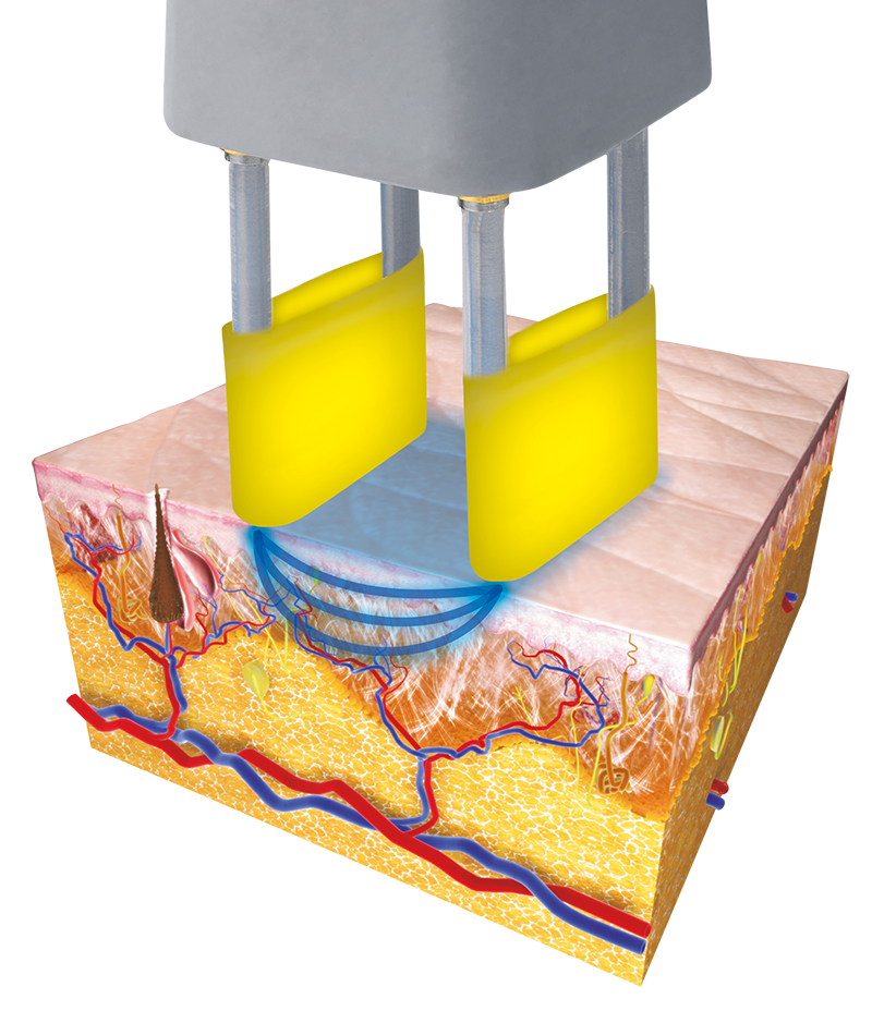 tissue-shrinkages-DEKA-Lasers